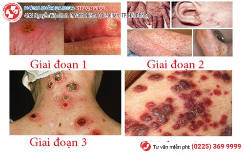 Các giai đoạn phát triển bệnh giang mai