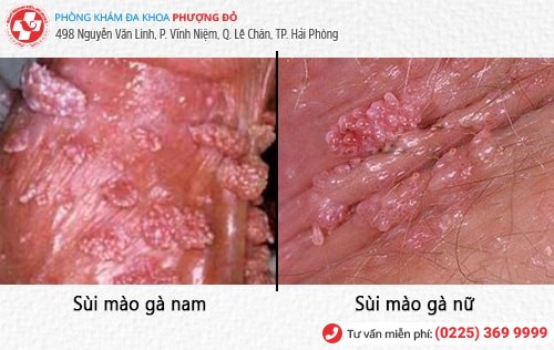 biểu hiện bệnh sùi mào gà