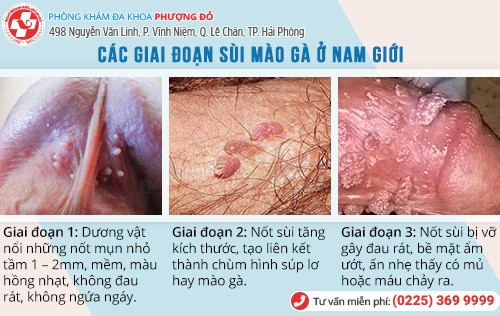 dấu hiệu sùi mào gà dương vật