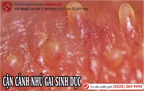 Cận cảnh nhú gai sinh dục