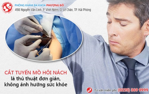 Cắt tuyến mồ hôi nách liệu có phải là giải pháp an toàn?