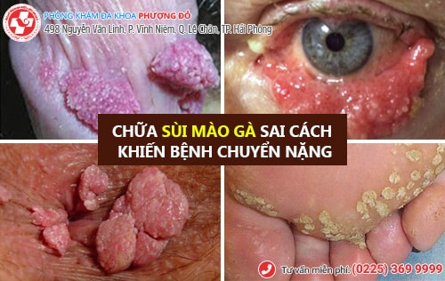 chữa sùi mào gà sai cách