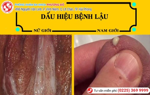 Dấu hiệu bệnh lậu ở cả nam và nữ