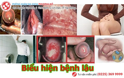 Hình ảnh bệnh lậu