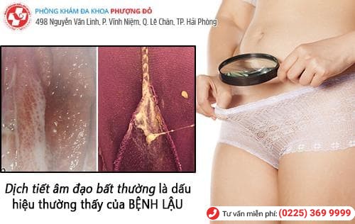 dấu hiệu bệnh lậu nữ