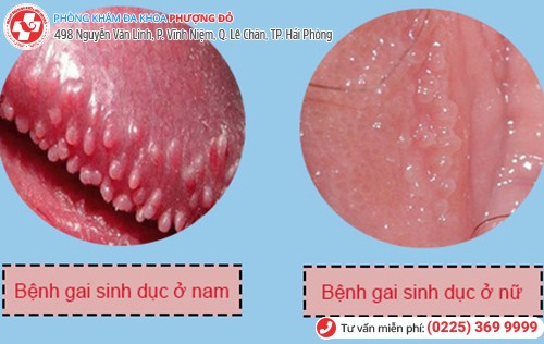 Hình ảnh gai sinh dục ở nam và nữ