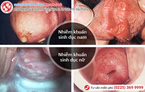 dấu hiệu nhiễm khuẩn sinh dục nam nữ