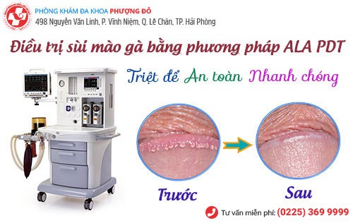 ALA-PDT - phương pháp hỗ trợ điều trị sùi mào gà tiên tiến