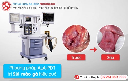 phương pháp chữa sùi mào gà