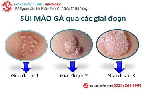 Các giai đoạn phát triển của sùi mào gà