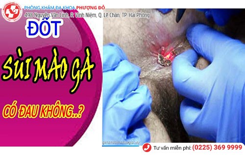 Thông thường đốt ú nhú mào gà sẽ có cảm giác đau nhẹ