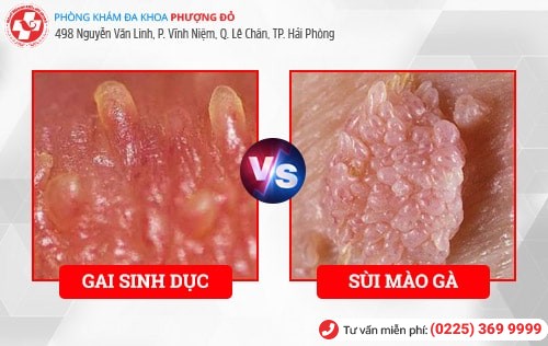 Hình ảnh gai sinh dục