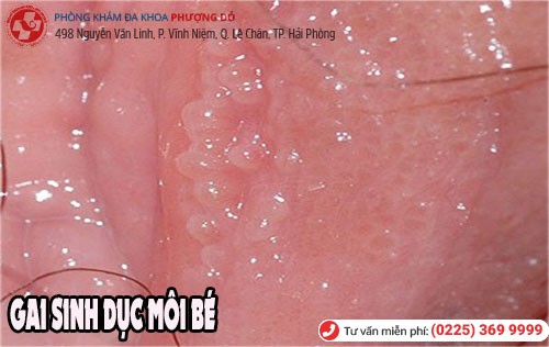 Gai sinh dục ở môi bé