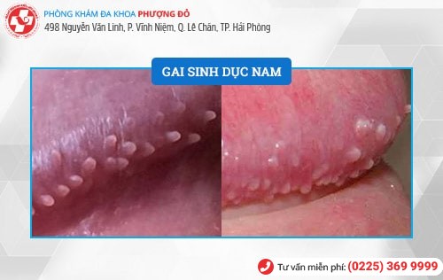 Hình ảnh gai sinh dục