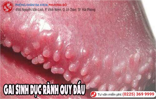 Gai sinh dục ở rãnh quy đầu