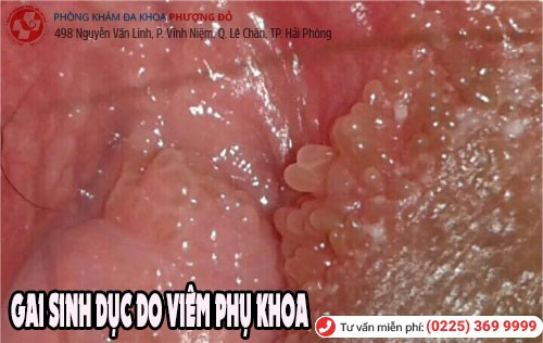 Gai sinh dục ở nữ giới