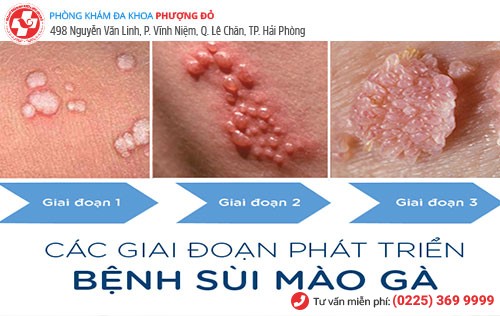 3 giai đoạn sùi mào gà