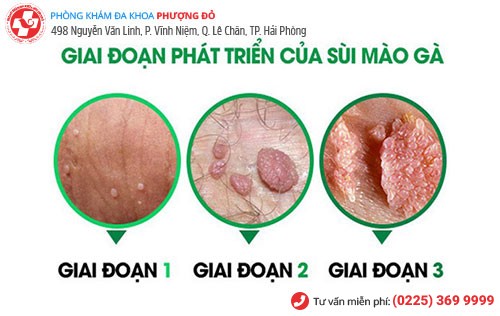 Hình ảnh sùi mào gà qua các giai đoạn