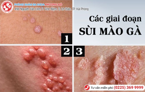 Các giai đoạn sùi mào gà