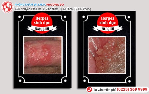 Herpes sinh dục ở nam và nữ