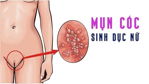 Mụn rộp sinh dục ở cơ quan sinh dục nữ