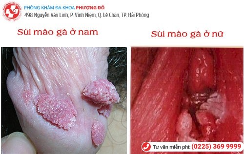 biểu hiện sùi mào gà