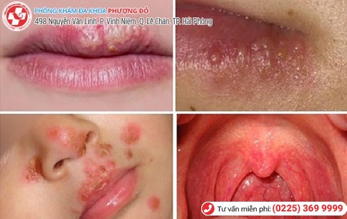 Mắc mụn rộp sinh dục vì nụ hôn của mẹ