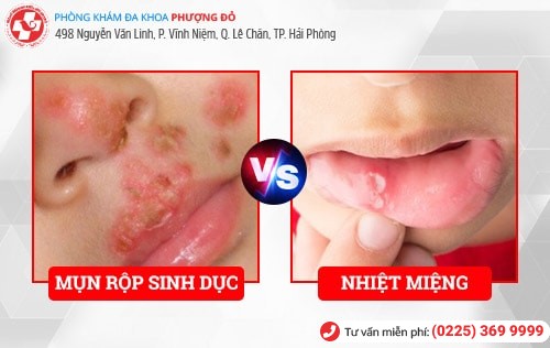 Mắc mụn rộp sinh dục vì nụ hôn của mẹ