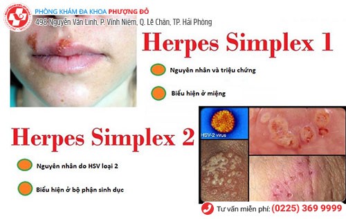 Virus HSV gây mụn rộp sinh dục gồm 2 loại: Type 1 và 2