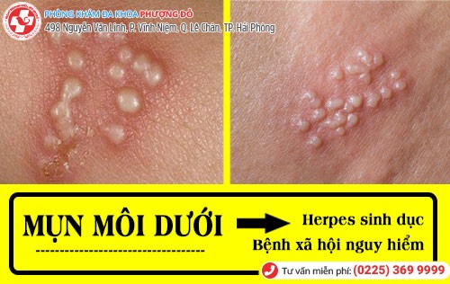 Mụn môi dưới là herpes sinh dục