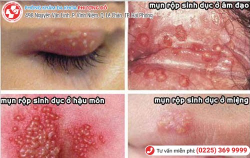 biểu hiện mụn rộp sinh dục nữ