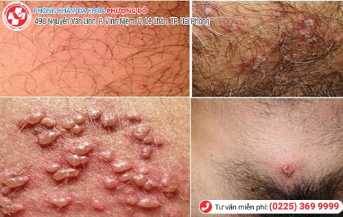 biểu hiện herpes sinh dục