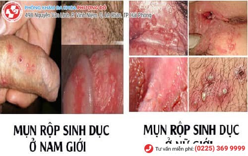 herpes sinh dục