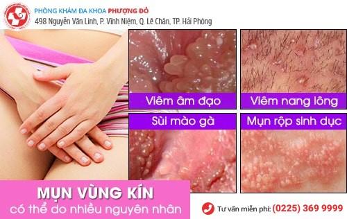 mụn vùng kín nữ