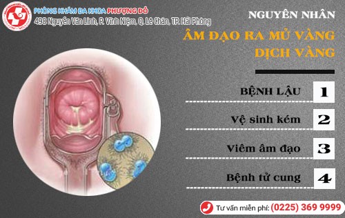 Nguyên nhân âm đạo ra mủ vàng, âm đạo ra dịch vàng