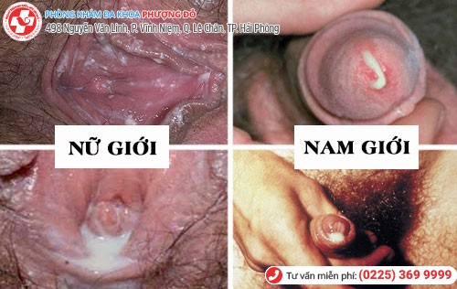 Nguyên nhân niệu đạo chảy mủ ở nam và nữ