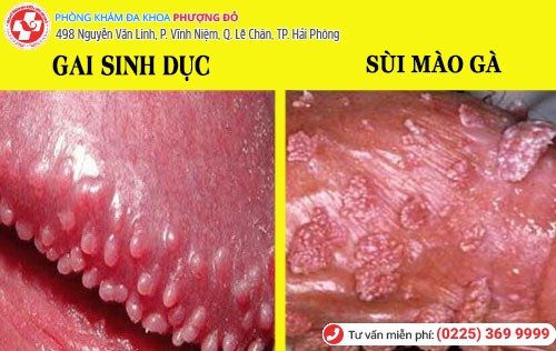 Phân biệt gai sinh dục và sùi mào gà