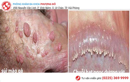 phân biệt sùi mào gà và hạt ngọc dương vật