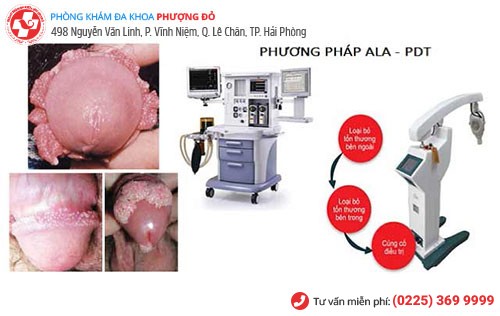 ALA - PDT - phương pháp chữa sùi mào gà hiệu quả lên đến 98%