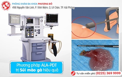 Chữa bệnh sùi mào gà bằng phương pháp nào hiệu quả nhất?