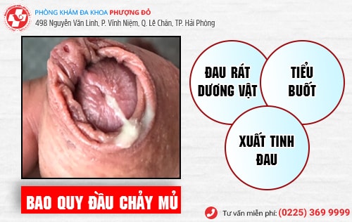 Bao quy đầu chảy mủ  - Cẩn thận bệnh lậu!