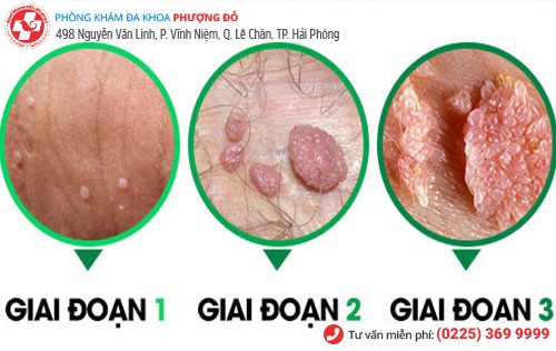 biểu hiện bệnh mồng gà