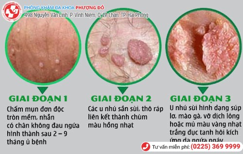 biểu hiện sùi mào gà