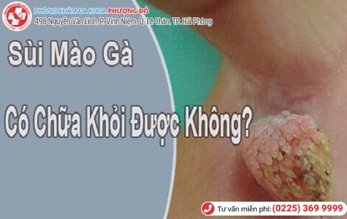 sùi mào gà có chữa khỏi được không