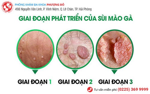 Các giai đoạn phát triển sùi mào gà