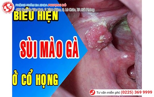 Hình ảnh sùi mào gà ở họng