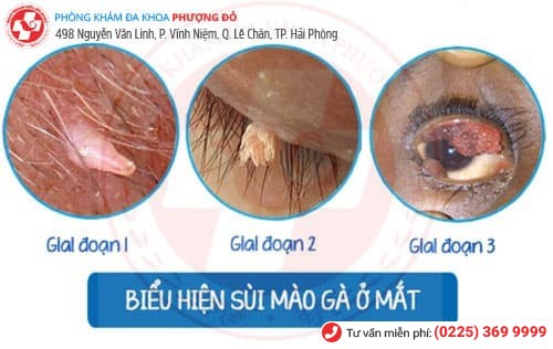 sùi mào gà ở mắt