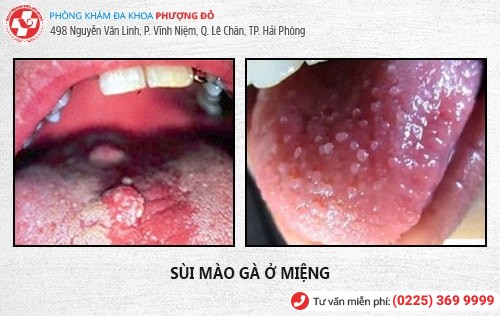 sùi mào gà ở miệng