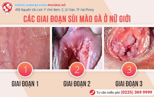 Sùi mào gà ở môi lớn môi bé qua các giai đoạn