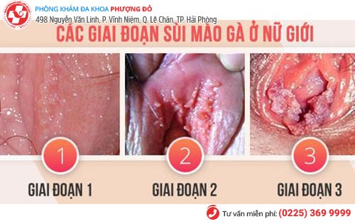 Hình ảnh sùi mào gà ở nữ